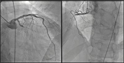 Case Report: Key Role of the Impella Device to Achieve Complete Revascularization in a Patient With Complex Multivessel Disease and Severely Depressed Left Ventricular Function